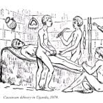 Une césarienne réussie en Ouganda en 1879, avant son adoption en Europe