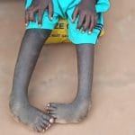 Pied bot : vaincre les peurs pour soigner les enfants à Ouagadougou